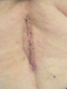 Suture line with staples on surgical incision
